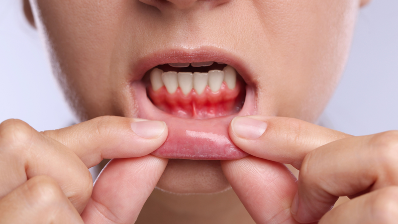 Tụt lợi chân răng có chữa được không?