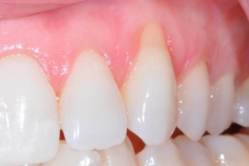 tụt lợi khi bọc răng sứ có thể do răng sử không đảm bảo chất lượng