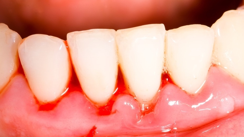 Tụt lợi răng lung lay có mấy mức độ? Cách khắc phục 2