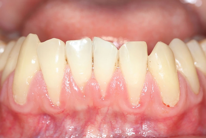 Tụt nướu là gì? Phương pháp điều trị tụt nướu 1