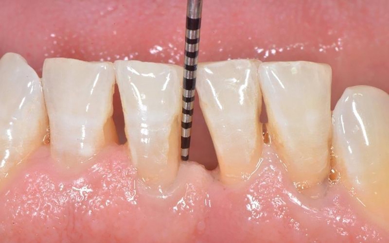 Tụt nướu là gì? Phương pháp điều trị tụt nướu 2