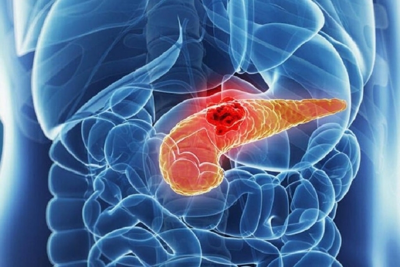 Tụy nhiễm mỡ: Nguyên nhân, triệu chứng và cách phòng ngừa bệnh hiệu quả 1