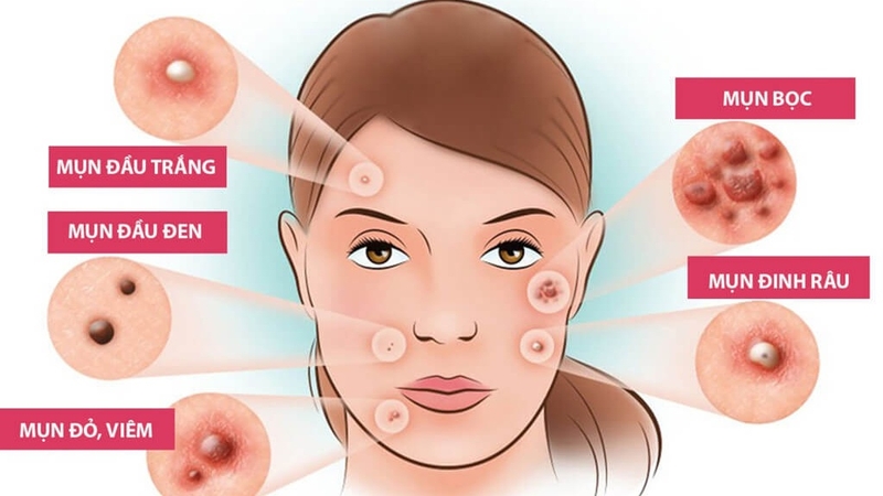 tuyến bã nhờn 02