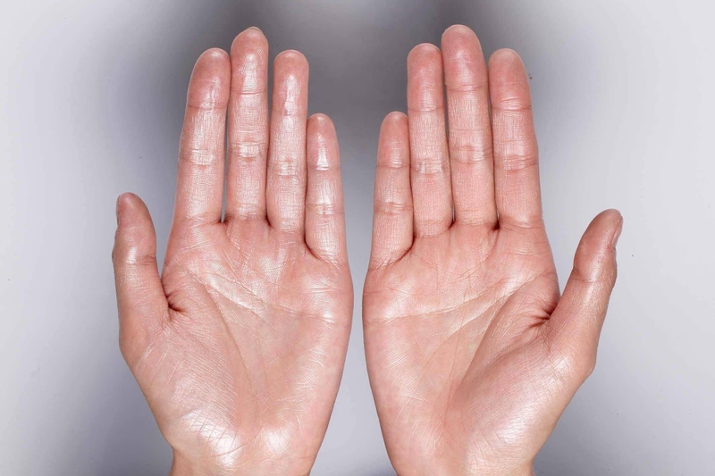 Cấu tạo, chức năng và một số bệnh lý liên quan đến tuyến mồ hôi dưới da 4