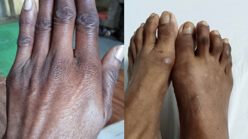 Tuyến thượng thận 6