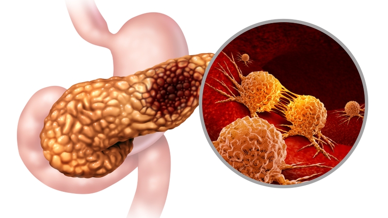 Tuyến tụy liên quan đến bệnh tiểu đường như thế nào? 4