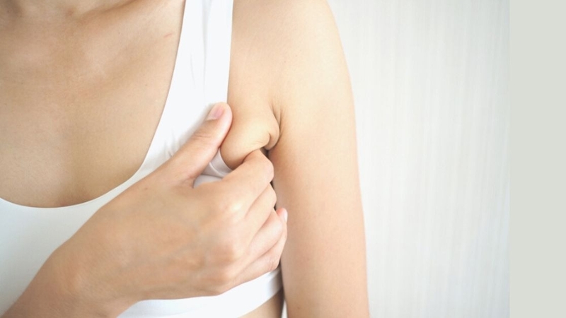 Tuyến vú phụ ở nách là gì? Biểu hiện của tuyến vú phụ 1