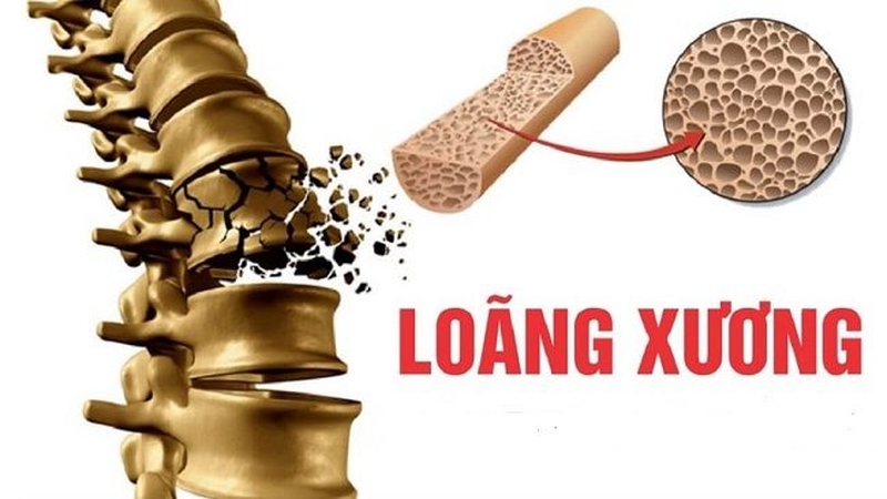 Tỷ lệ loãng xương ở Việt Nam ngày càng tăng: Nguyên nhân, cách phòng ngừa hiệu quả 2