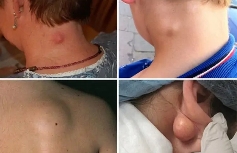 U bã đậu không gây nguy hiểm nhưng cũng không được chấp nhận sống chung với nó