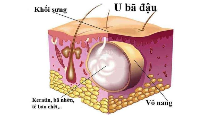 U bã đậu là một khối u lành tính, bên trong chứa chất bã mềm màu vàng/màu trắng đục