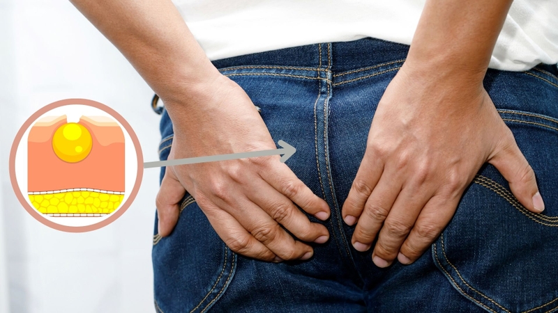 U bã đậu ở mông hình thành do sự tắc nghẽn của tuyến bã nhờn dưới da
