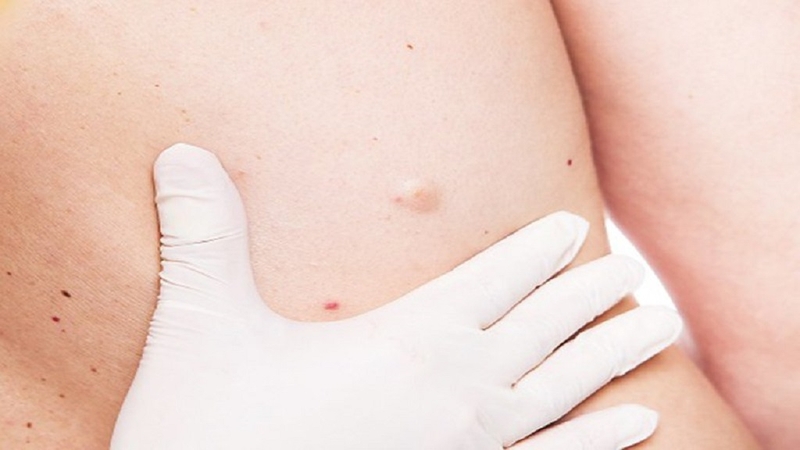 U bã đậu ở nách có nguy hiểm không? Cách điều trị u bã đậu ở nách 1