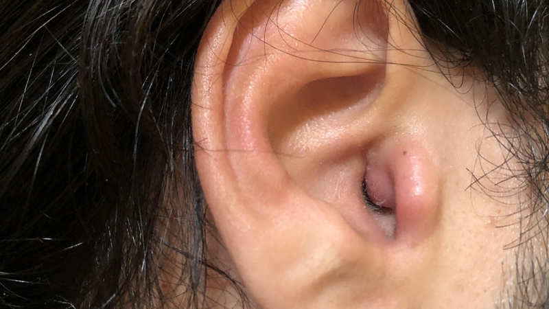 Vùng da quanh tai đau nhức, căng tức hoặc nóng đỏ có thể là dấu hiệu u bã đậu đang bị viêm