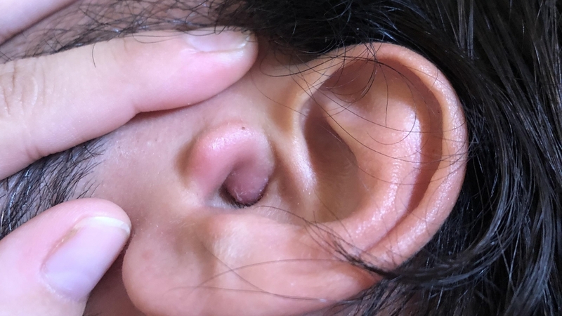 U bã đậu tồn tại lâu năm nhưng không được xử lý triệt để cũng có nguy cơ tái phát nhiều lần