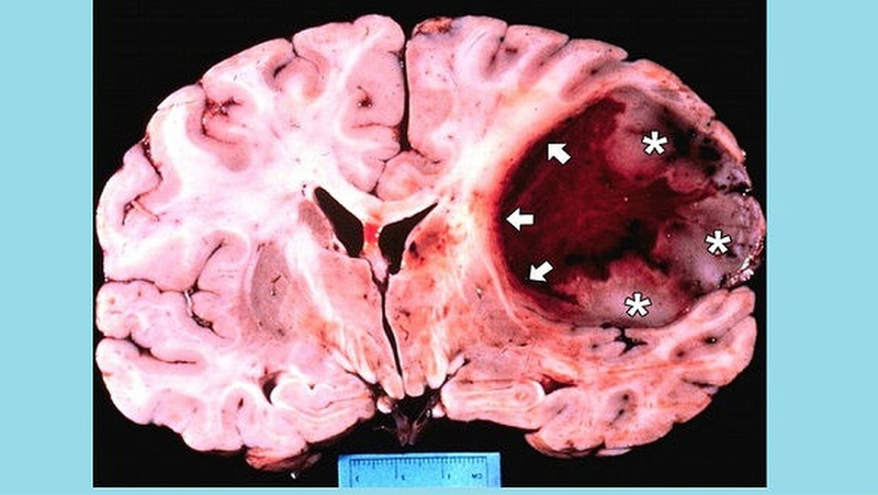 U bao thần kinh ngoại vi ác tính: Nguyên nhân, triệu chứng và điều trị 1