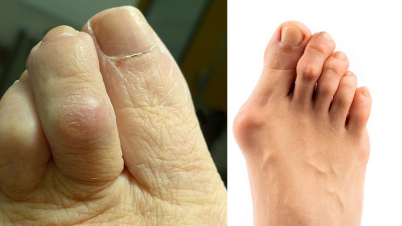 Khối lồi ở ngón chân cái có thể liên quan đến gout, bunion hoặc các bệnh lý xương khớp