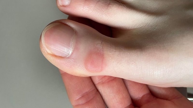 Không nên tự ý chọc, nặn hoặc điều trị u bướu ở ngón chân tại nhà khi chưa có chỉ định