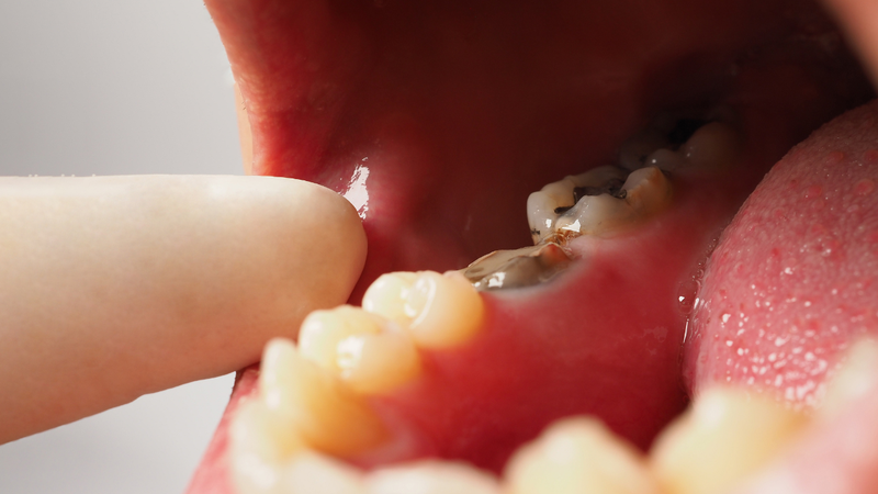 Các bệnh lý như sâu răng nặng, viêm tủy, viêm quanh chóp răng có thể gây viêm mạn tính ở vùng quanh chân răng