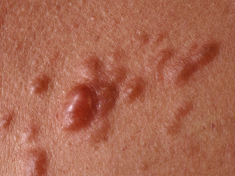 U cơ trơn ở da là gì? Nguyên nhân, triệu chứng và cách điều trị 2