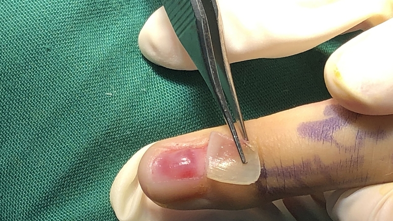 U cuộn mạch dưới móng - Quá trình phẫu thuật diễn ra như thế nào? 2