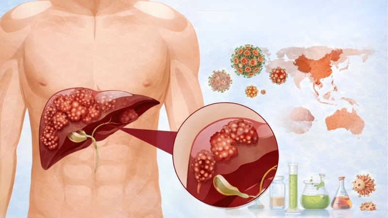 Muốn biết u gan đa ổ có phải là ung thư không cần thăm khám để xác định chính xác bản chất tổn thương