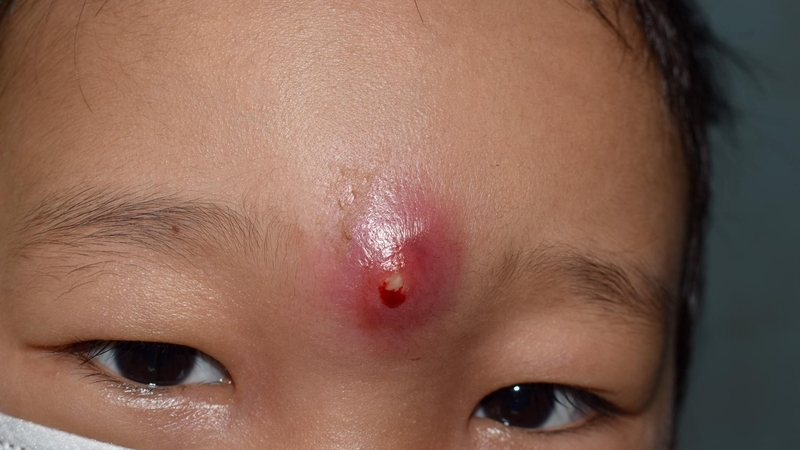 U hạt mạn tính: Bệnh lý di truyền hiếm gặp 1.jpg