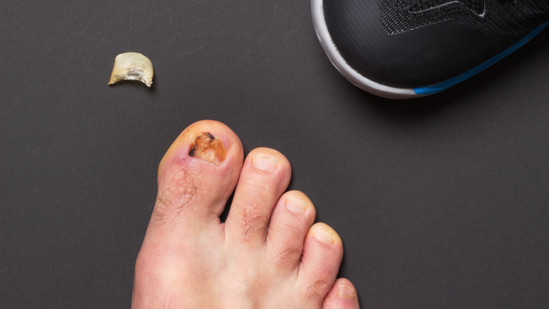 U hạt nhiễm khuẩn: Những thông tin quan trọng cần biết 4