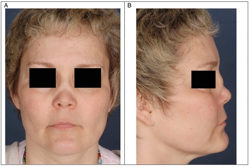 U hạt Wegener là bệnh gì? Nguyên nhân, triệu chứng và cách điều trị 1