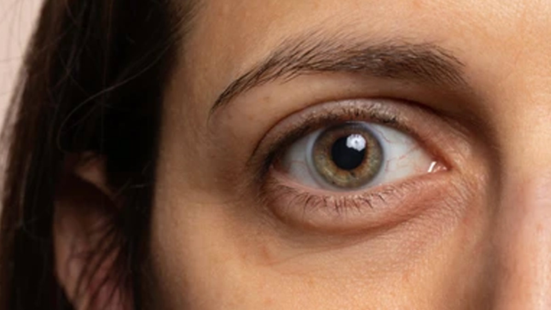 U hốc mắt - Bệnh lý về mắt không thể bỏ qua 2