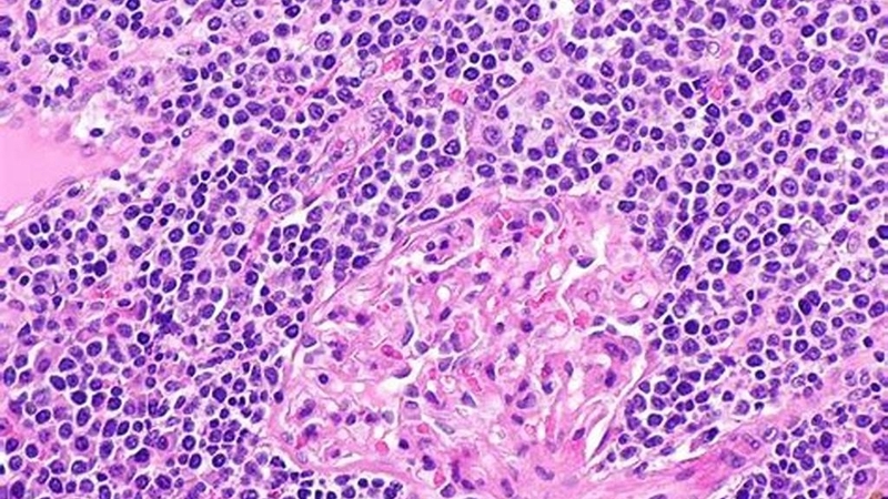 U lympho không Hodgkin tế bào B lớn tỏa rộng: Nguyên nhân, triệu chứng và điều trị 1