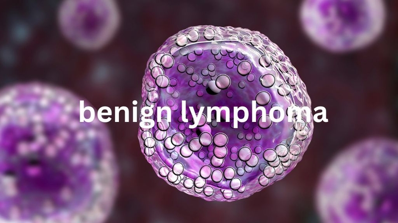 U lympho lành tính: Có cần lo lắng? Góc nhìn từ bác sĩ chuyên khoa 1