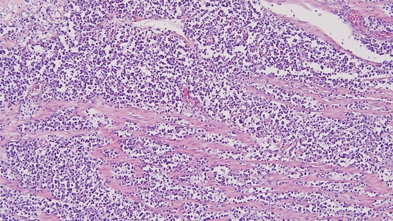 U lympho ruột non: Nguyên nhân, triệu chứng và phương pháp điều trị hiệu quả 1