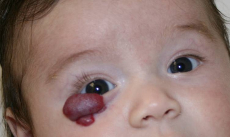 U mạch máu có phải là ung thư không? Nguyên nhân và cách điều trị u mạch máu 2