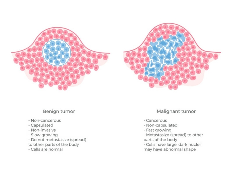 U mạch máu có phải là ung thư không? Nguyên nhân và cách điều trị u mạch máu 3