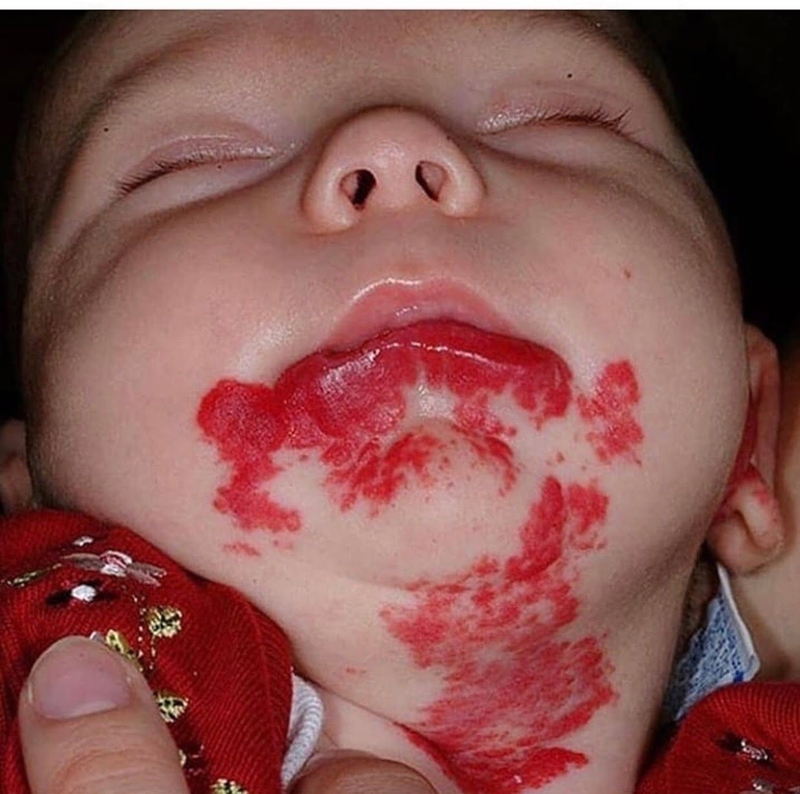 U mạch máu có phải là ung thư không? Nguyên nhân và cách điều trị u mạch máu 4