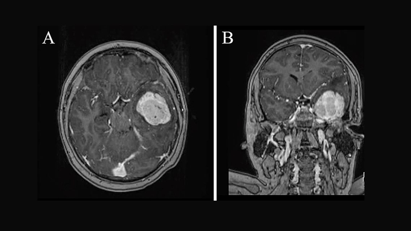 U màng não thái dương: Đặc điểm, triệu chứng và cách điều trị 1