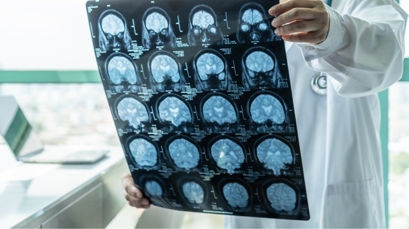 U màng não thất ở trẻ em là bệnh gì? 3