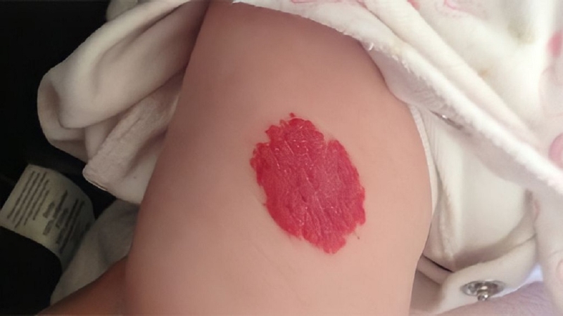 U máu bẩm sinh: Nguyên nhân, triệu chứng và cách điều trị bệnh hiệu quả 4