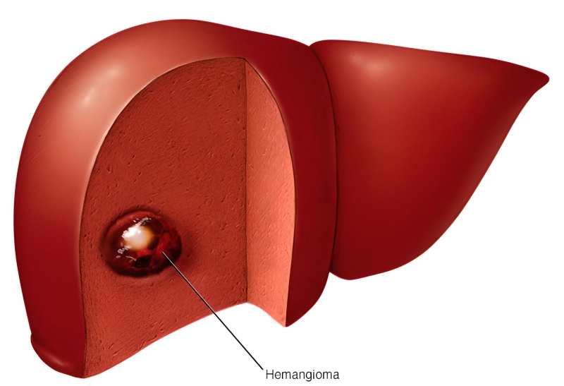 U máu có nguy hiểm không? Nguyên nhân và phương pháp điều trị u máu 2