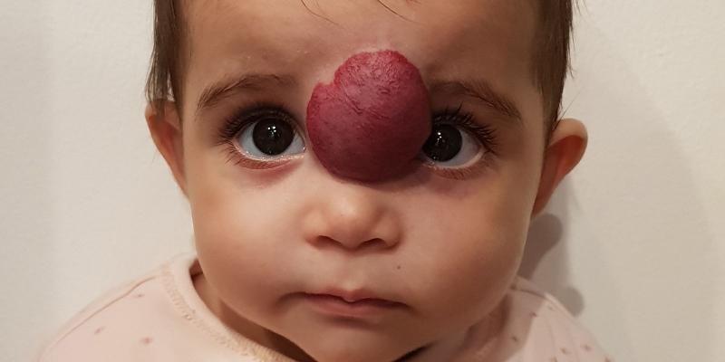 U máu có nguy hiểm không? Nguyên nhân và phương pháp điều trị u máu 3