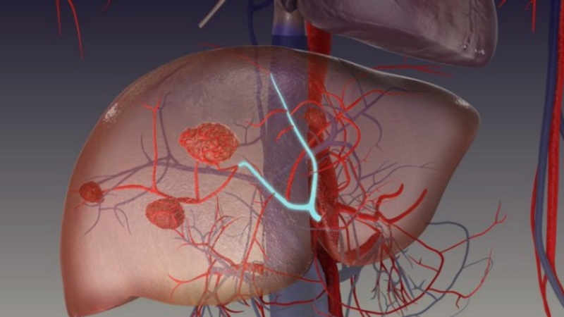 U máu gan: Nguyên nhân, triệu chứng và phương pháp điều trị 1