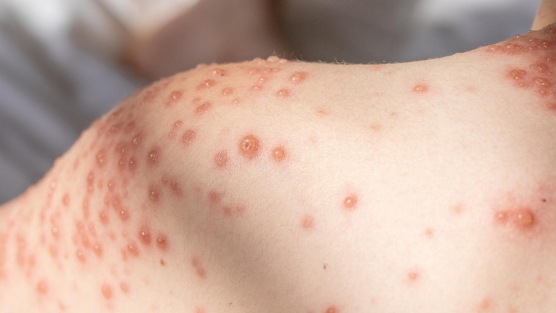 U mềm lây ở trẻ thường là nốt sẩn bóng, lõm giữa, ít đau