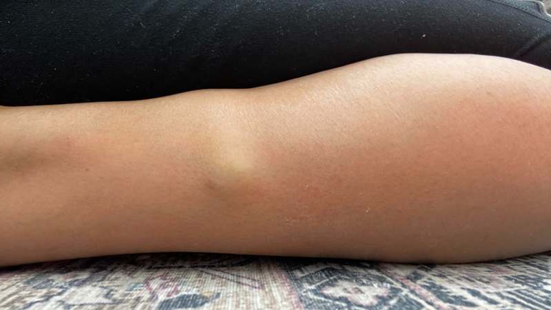 U mỡ ở chân có nguy hiểm không? Cần lưu ý điều gì? 2