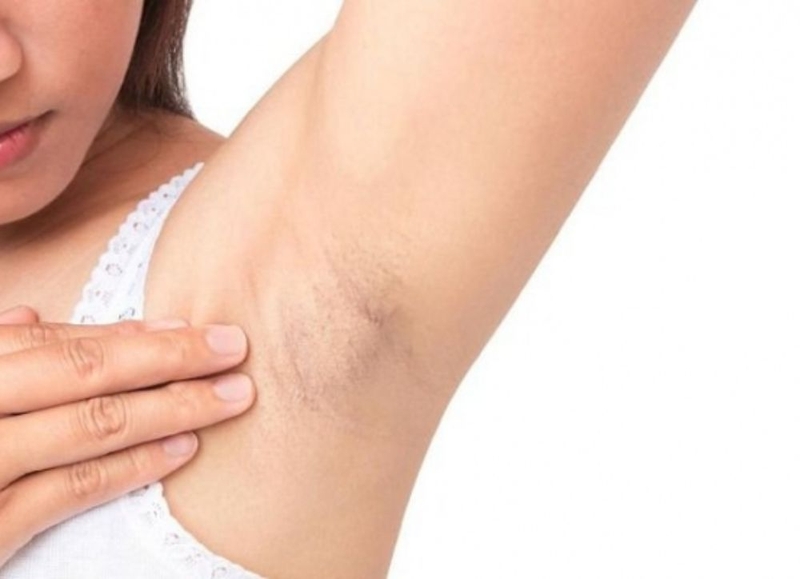 U mỡ ở nách có nguy hiểm không? Dấu hiệu nhận biết và cách điều trị 2