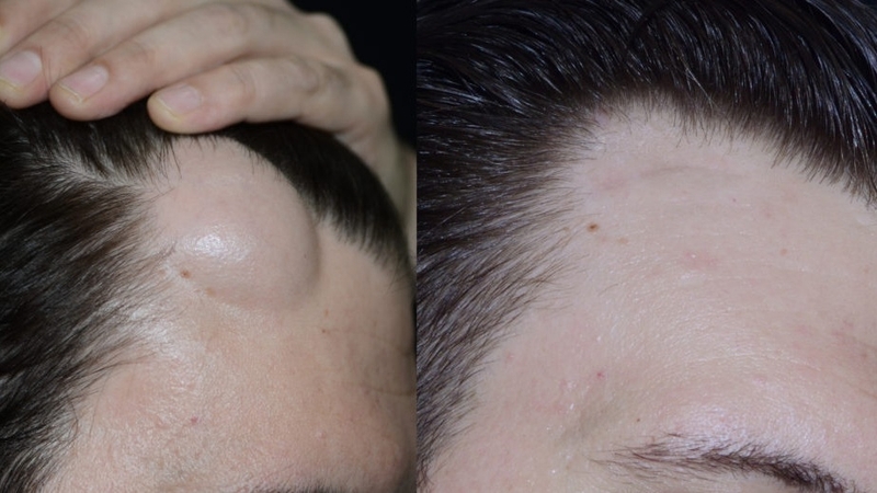 U mỡ trên mặt: Nguyên nhân vì sao? Làm sao để phát hiện? 1