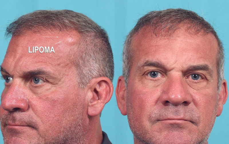 U mỡ trên mặt: Nguyên nhân vì sao? Làm sao để phát hiện? 2