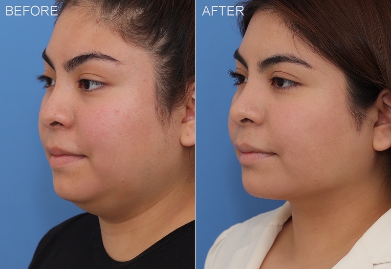 U mỡ trên mặt: Nguyên nhân vì sao? Làm sao để phát hiện? 4