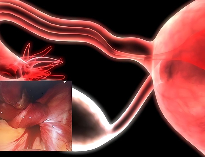 U nang bì buồng trứng khi mang thai nguy hiểm không? 4