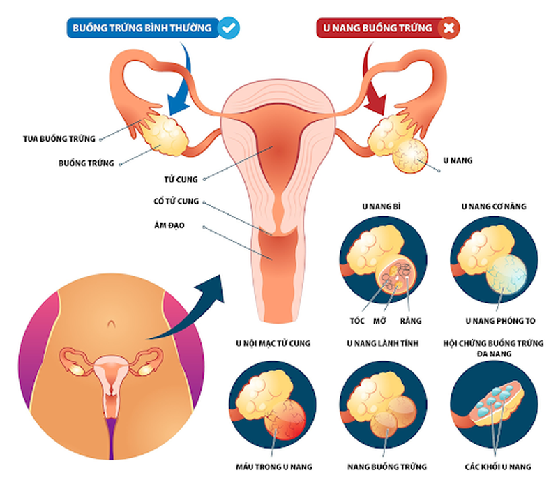 U nang buồng trứng kiêng ăn gì? Chế độ ăn phù hợp cho bệnh nhân u nang 2