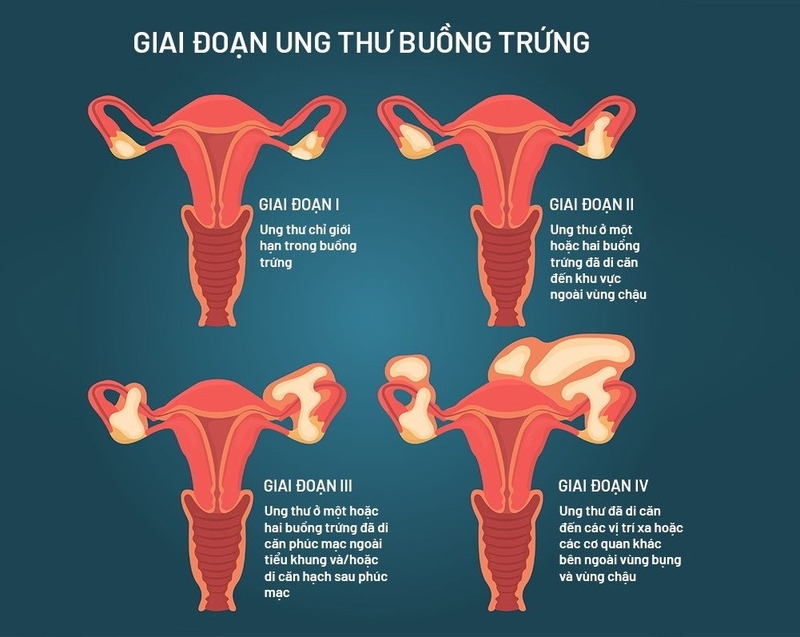 Những dấu hiệu cảnh báo u nang buồng trứng ác tính mà bạn cần để ý 2